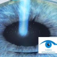 ¿Tiene riesgos para la salud la operación láser de miopía?